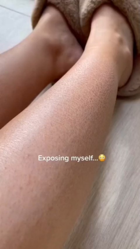 The image shows a close-up of a person's legs, with the focus on the lower leg and foot. The skin appears light-toned with visible texture, and the leg bends slightly. A section of a light-colored blanket or sheet fills the lower right corner, with a person's foot resting near soft slippers. The text overlay is at the bottom of the frame.