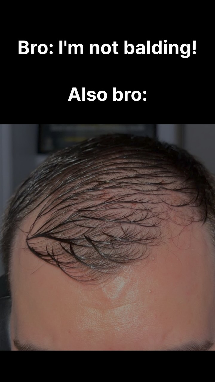 The cover image shows the top of a man's head with thinning hair and a receding hairline. Text overlays the image.