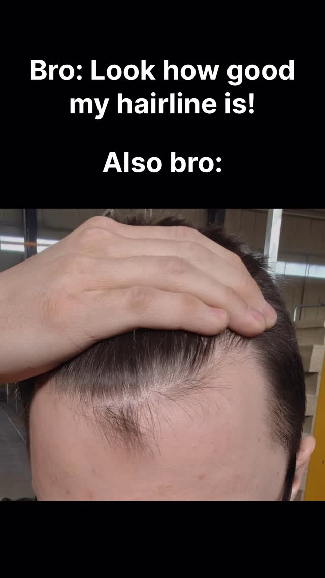 The image shows a close-up of a person's forehead, with a receding hairline. A hand is placed on top of the head. Text overlays the image, creating a humorous contrast between an initial boast and the reality of hair loss.