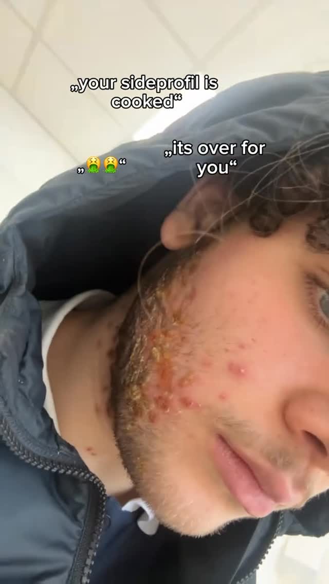 The image shows a close-up of a person's face. The person appears to be a young male with short, partially curly hair and fair skin. The focus is on the side profile, showcasing a visible skin issue, possibly acne or a skin condition, concentrated primarily around the lower face and neck. There are visible red bumps and some yellowing of the skin, suggesting inflammation or infection. The person's expression is not fully visible, but the overall tone leans towards a look conveying discomfort or concern. The background is a light-colored, possibly indoor, environment, and the person is wearing a dark-colored jacket. The main element is the person's distressed skin condition on display.