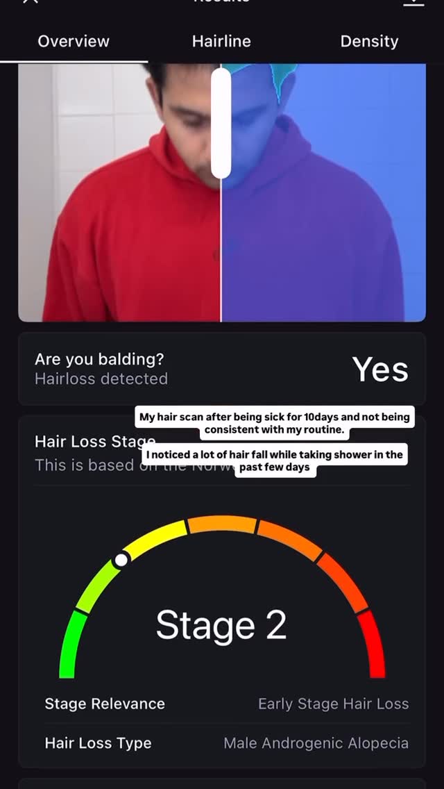 The image from a phone app screen shows a man's haircut scan results, splitting his face in two for comparison. Text overlay indicates a hair loss stage and includes commentary on recent hair loss.
