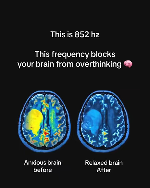 The image is a split-screen comparison against a black background, featuring stylized cross-sections of human brains. The left side is labeled "Anxious brain before" and displays a brain section in shades of yellow, blue, and red, with a prominent yellow area suggesting high activity or anxiety. The right side, labeled "Relaxed brain after", shows a brain section in cooler tones of blue and green, with a reduced area of high activity, representing a relaxed state. Above the brain images, white text states "This is 852 hz" and "This frequency blocks your brain from overthinking."