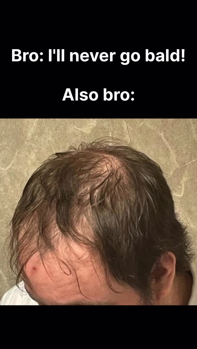 The image is divided into two primary sections with a black background at the top and the bottom. At the bottom, there's a close-up photo of a person's head. The hair is thinning, particularly at the crown, indicating male pattern baldness. The hairline has receded. The person's head is a light skin tone, and the shadows indicate a light source, possibly overhead. In the upper section, white text is overlaid against a completely black background, forming the video's hook.