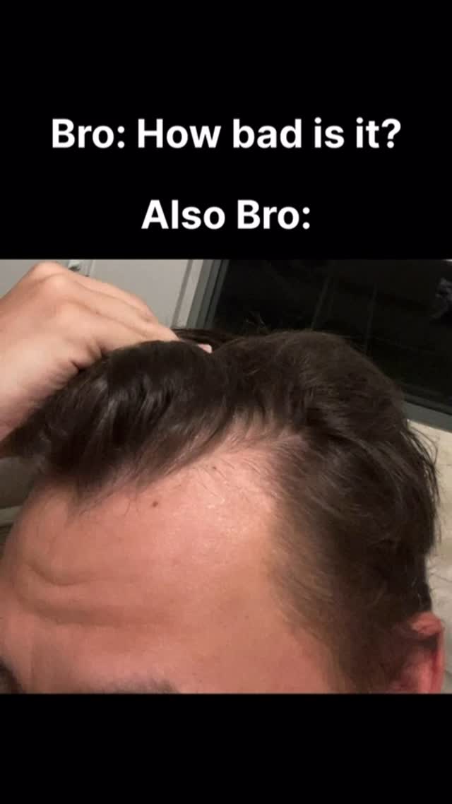 The cover image shows a close-up of a man's forehead and hairline. He is holding the top of his head, and his hair appears to be thinning at the front and top. Text is overlaid on the image.