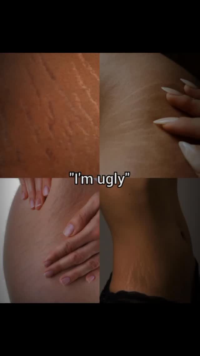 The image is a grid of four close-up shots of different parts of a person's body, likely a female. The shots show skin with stretch marks and subtle variations in lighting, highlighting the texture and form. The arrangement is simple, yet the close-up perspective directs the viewer's focus to the central subject matter. Text is overlaid on the image.