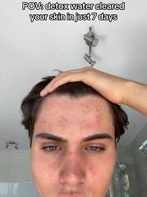 The cover image shows a young man with acne on his forehead and face, looking down, with his hand on top of his head. The background suggests a bathroom setting, with a shower head and a partial view of the wall and ceiling.
