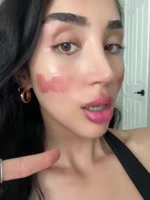 A close-up shot of a woman's face. She has long black hair and is wearing gold hoop earrings. Her skin has a pinkish discoloration on her cheek, and her lips are a bright pink color. She is looking to the side with a slight smile, and her finger is pointing towards the pink area of her cheek. Behind her is a blurred white wall and door.