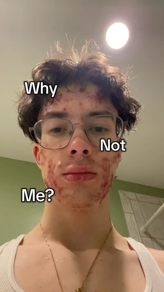 A close-up selfie of a young man with acne on his face. The image has text overlayed to the main character's face.