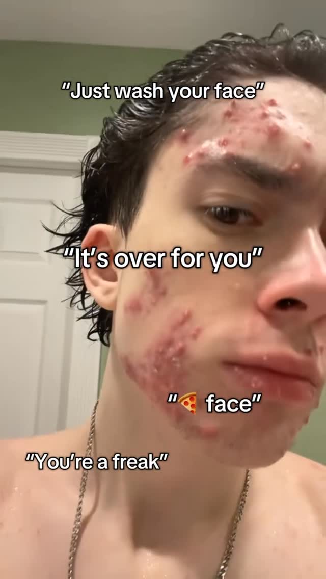 A close-up shot of a young man's face, showing skin affected by acne. His skin is red and inflamed, with numerous prominent pimples and blemishes, particularly on his forehead, cheeks, and chin. Overlaid text bubbles include phrases such as "Just wash your face", "It's over for you", and a pizza emoji used to describe the face. The background is a light-colored wall. The man has short, dark hair.