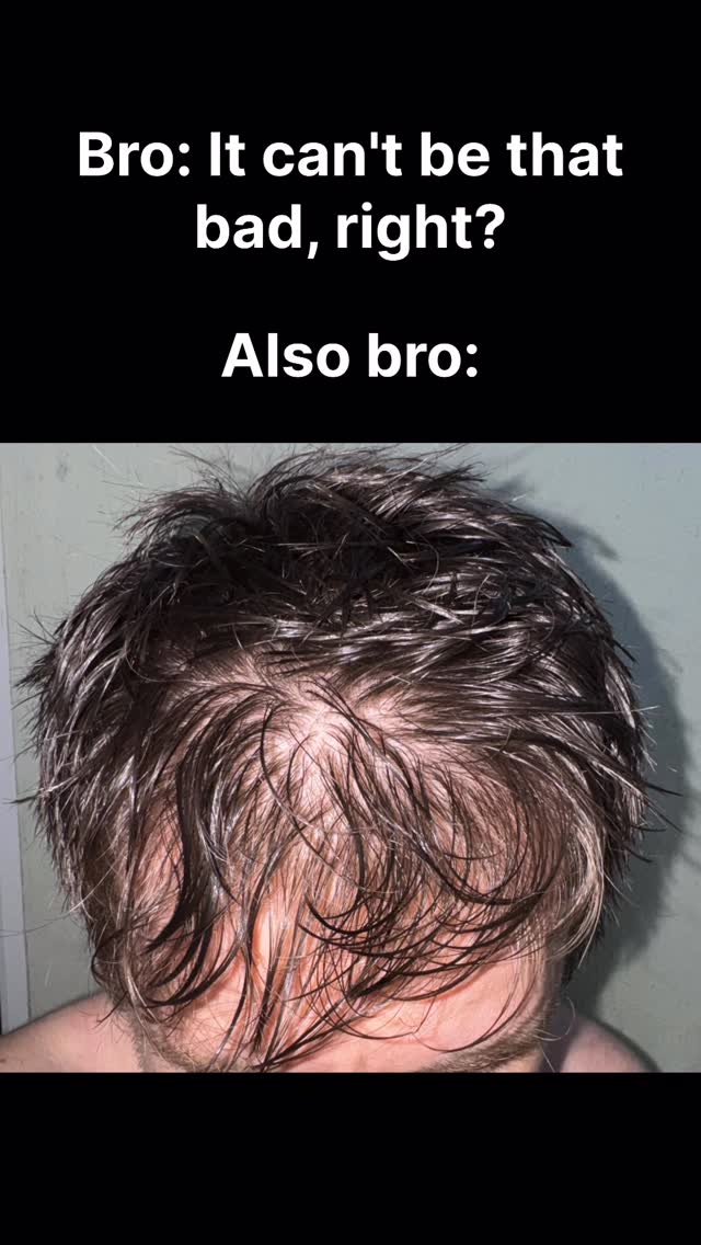The image shows the top of a man's head with visible hair loss. The hair is dark and appears wet, with significant thinning and visible scalp particularly at the crown. Text overlay is present at the top and bottom of the image.