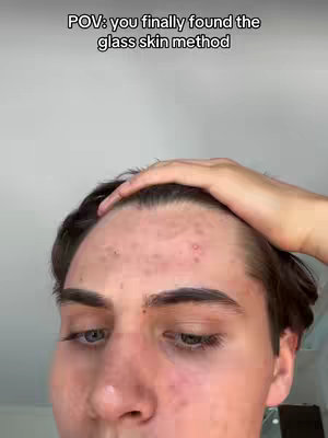 Close-up shot of a young man's face, focusing on his forehead, eyes, and the top of his head. The background is a plain, light gray. The man has short, dark hair and noticeable acne or blemishes on his forehead. He appears to be in the foreground. A hand is positioned on his forehead. Overlaid text at the top reads, 'POV: you finally found the glass skin method'.