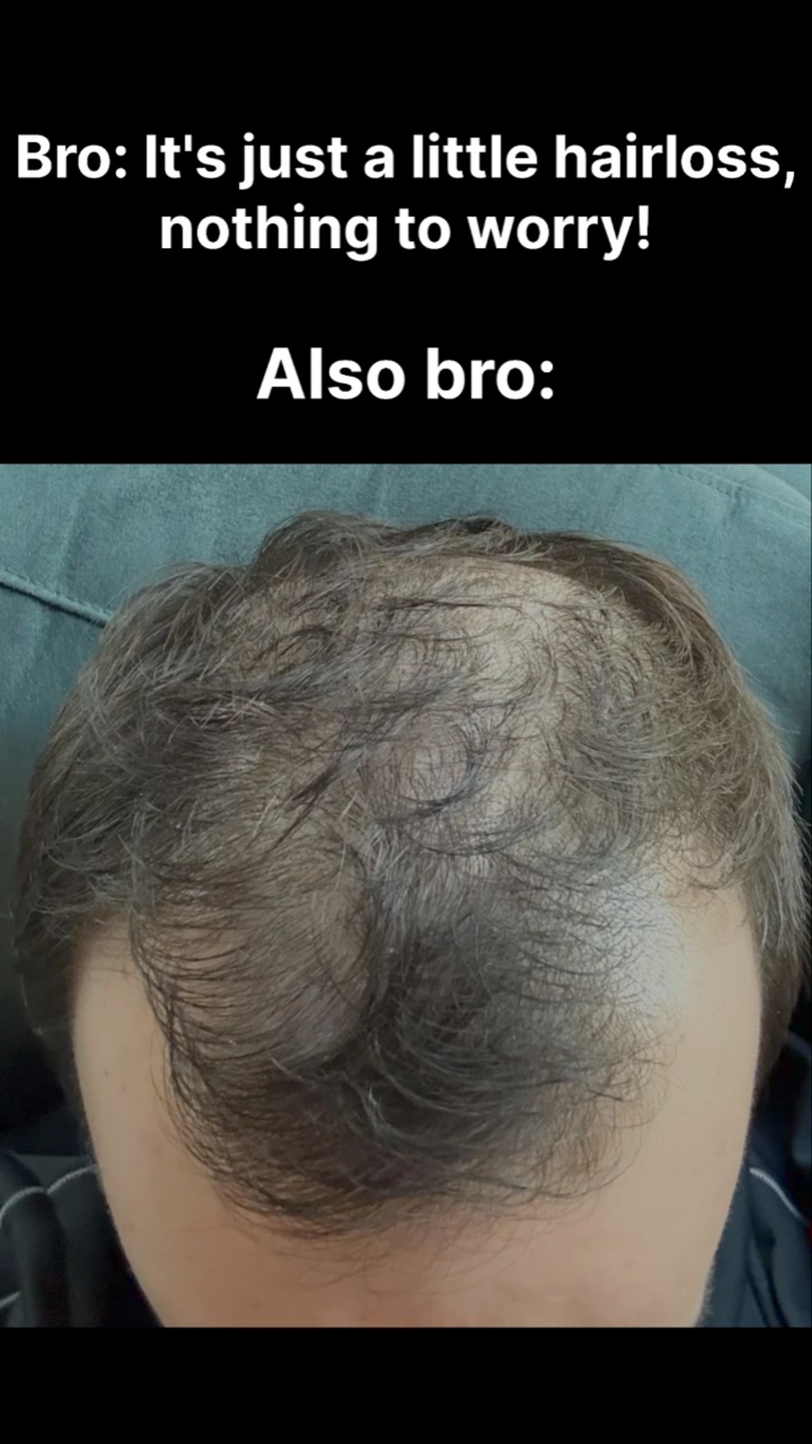 The cover image displays a top-down perspective of a man's head, showing a prominent balding spot on the crown. Above, text in white reads, "Bro: It's just a little hairloss, nothing to worry!" and below, "Also bro:," contrasting the perceived initial problem with the actual condition.