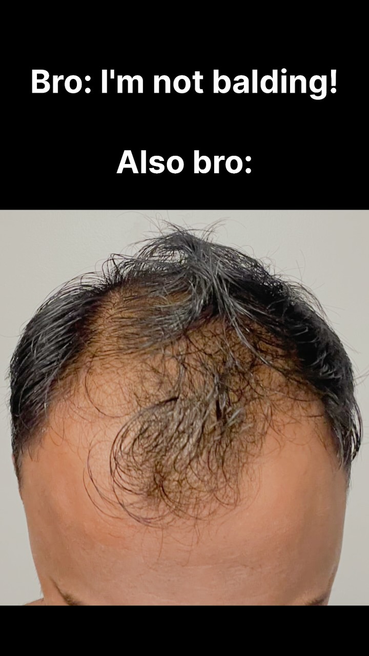 An overhead shot of an individual's head, focusing on thinning hair and a receding hairline. Text overlays provide additional context.