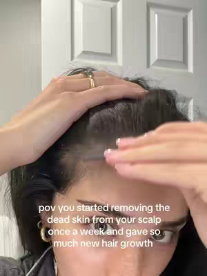The image shows a close-up of a person's face, focusing on the top of their head and hairline. Their hands are partially visible as they lift their hair, and the text overlayed indicates insights on hair health. The skin on the scalp looks visible.