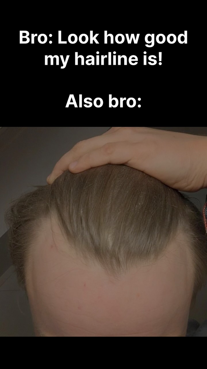 The image shows the top of someone's head, with part of their forehead and hairline visible. Above, the caption "Bro: Look how good my hairline is!" and "Also bro:" is written in white text over a black background. The hairline appears to be receding.