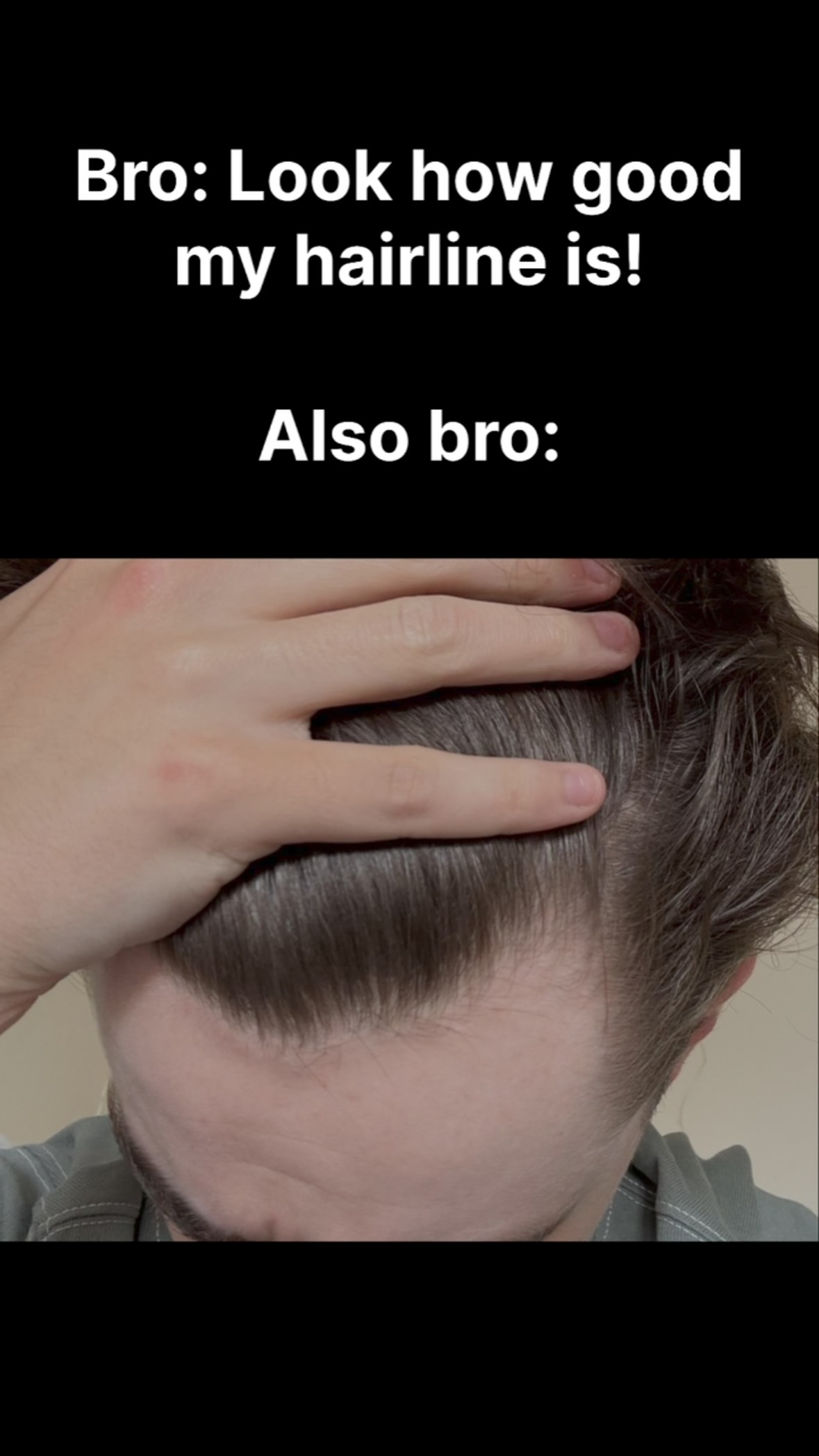 The image is a before-and-after showing a man's hairline. Above the man's forehead is the phrase "Bro: Look how good my hairline is!". Below is "Also bro:" and a close up shot of the man's hairline showing clear hair loss.