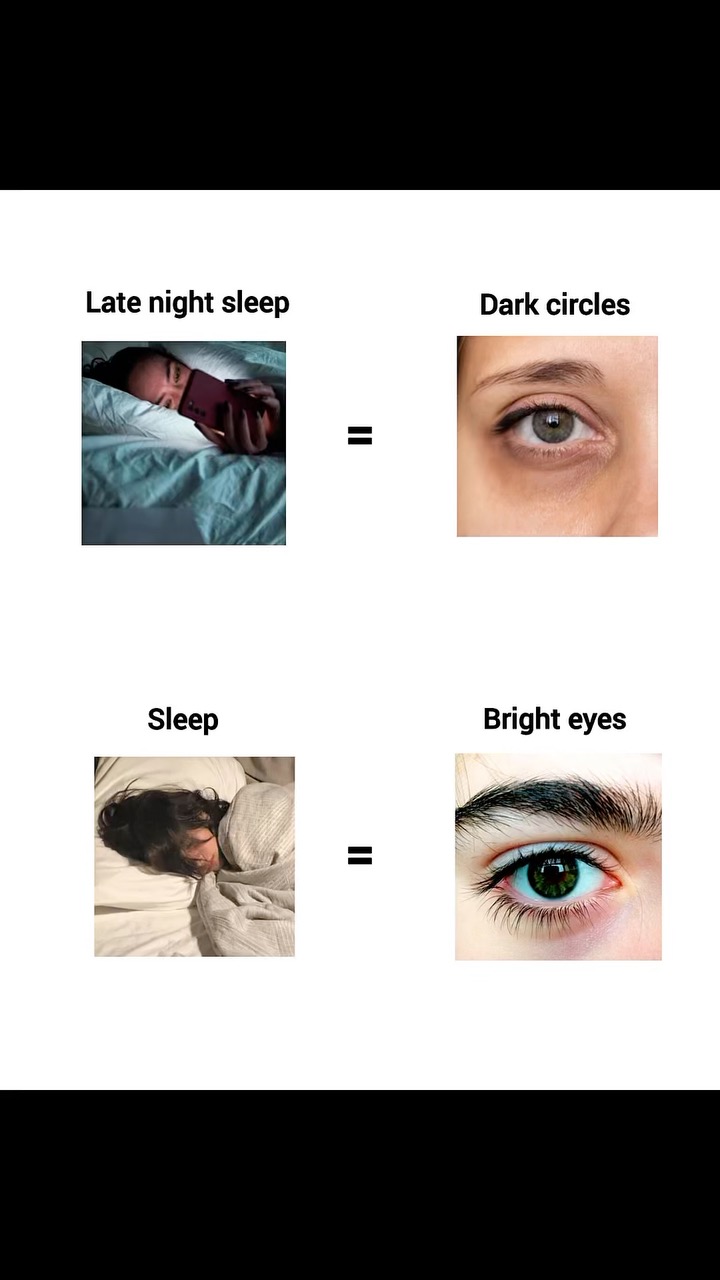 The image is a split-screen comparison. On the top left, a person is lying in bed with a phone, captioned as 'Late night sleep', leading to 'Dark circles' on the top right, showing a close-up of an eye with dark circles. Below, the image shows a person sleeping with the caption 'Sleep' on the left and 'Bright eyes' on the right, showcasing a close-up of an eye with bright appearance.