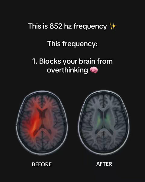 The cover image is a black background featuring text and illustrations. At the top, it states "This is 852 hz frequency" with two sparkle emojis. Below, it says "This frequency:" followed by "1. Blocks your brain from overthinking" with a brain emoji. Two brain diagrams are shown side-by-side; one labeled "BEFORE" and one labeled "AFTER", each illustrating the brain's state.
