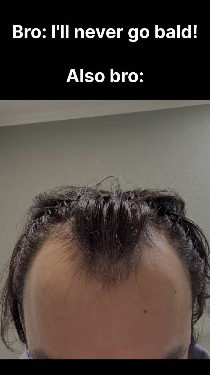 The image is split into two sections. The top half is a black rectangle with white text over it. The text says, "Bro: I'll never go bald!" and "Also bro:" The bottom half is a close-up shot of a person's head. The person has dark, wet hair with a receding hairline.