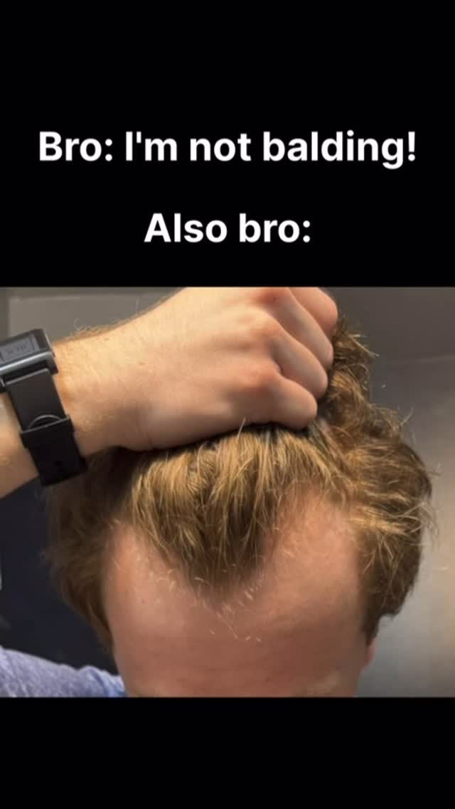 The image shows a close-up of a man's head, focusing on thinning hair at the hairline. Text overlays the image, providing context. The primary colors are neutral tones and skin colors, with the layout drawing attention to the hair and text.