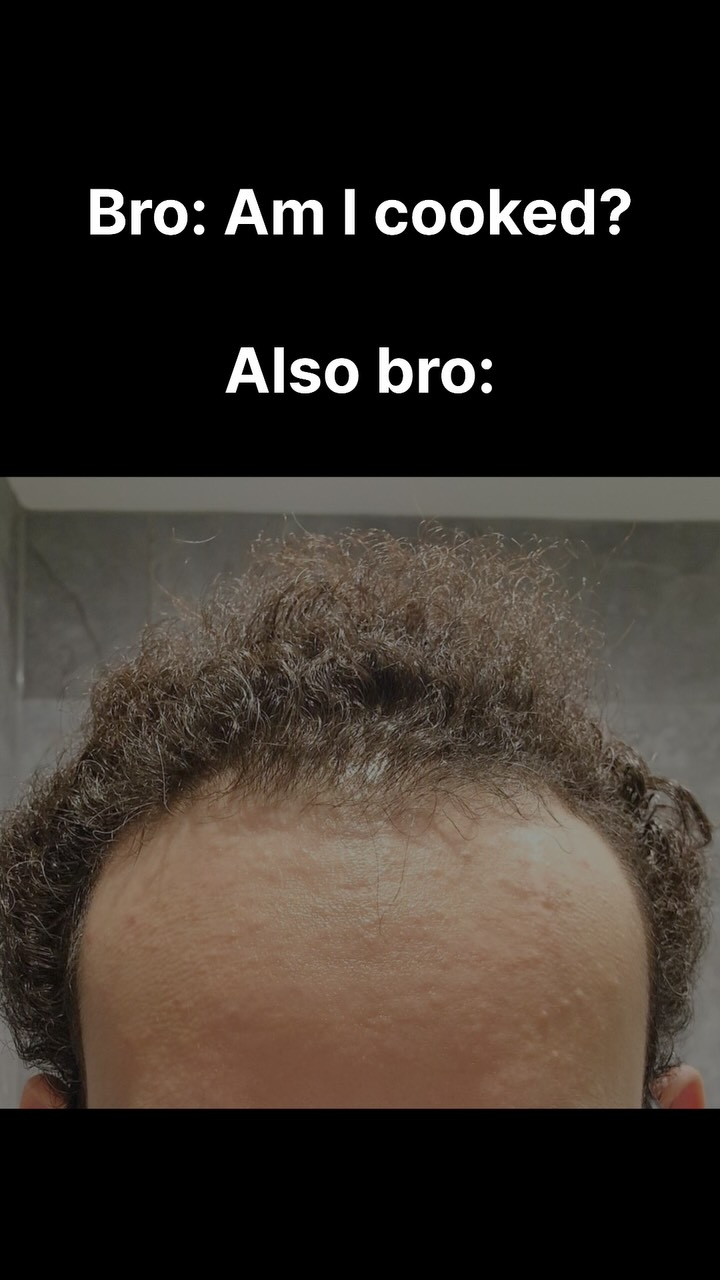 The image shows the top portion of a person's head with dark, curly hair and a visible forehead. The forehead has some small bumps. Above the forehead is text on a black background in a sans-serif font that reads "Bro: Am I cooked?" and "Also bro:"