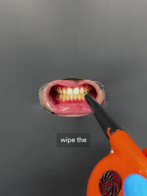 A static image shows a person's mouth opened wide, with a mouth retractor in place, highlighting the teeth. The teeth appear stained and discolored. An orange and black device, possibly a dental tool, is aimed towards the teeth, and a text overlay reads 'wipe the'. The background a grey, and the overall composition is simple and direct.