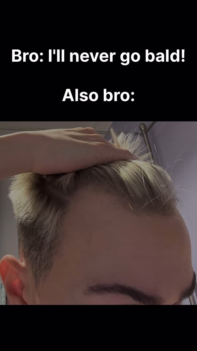 A close-up shot showcasing a man's forehead and scalp. The image highlights the hairline with sparse hair growth at the top, suggesting hair loss. Overlaid text adds context.