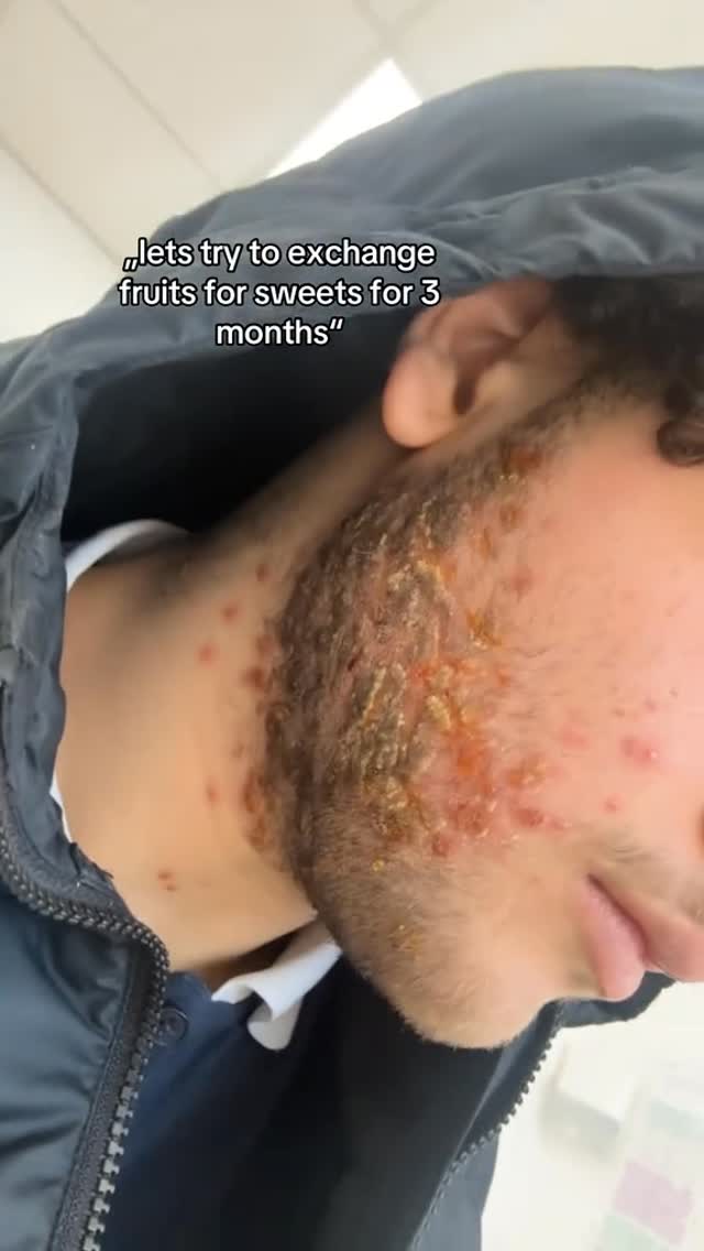 The image is a close-up shot of a man's face and neck, focusing on skin issues. The man is seen from the chest up, wearing a dark jacket. The main area of focus is the man's beard and neck which is covered in red pimples and areas of broken skin and scabs. The text overlay reads "lets try to exchange fruits for sweets for 3 months".