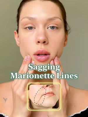 A close-up of a woman's face with hands cupping her cheeks. The text overlay reads "Sagging Marionette Lines" in a light green font. Below her lips is a yellow rectangle with a dotted outline of the area where the marionette lines appear, with the lines indicated.