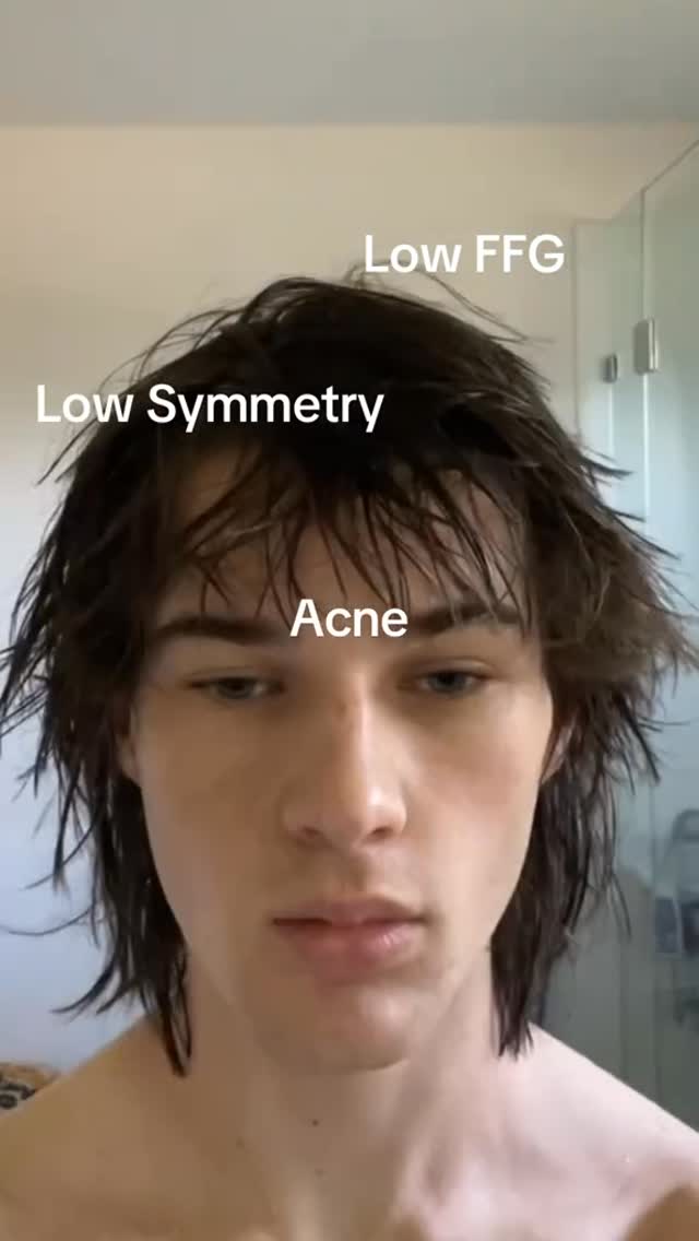 A selfie-style shot of a young man in a bathroom. The man has wet, dark hair, and is looking directly at the camera with a neutral expression. Overlaid text labels highlight facial features: "Low FFG", "Low Symmetry", and "Acne". The background shows a blurred white wall.