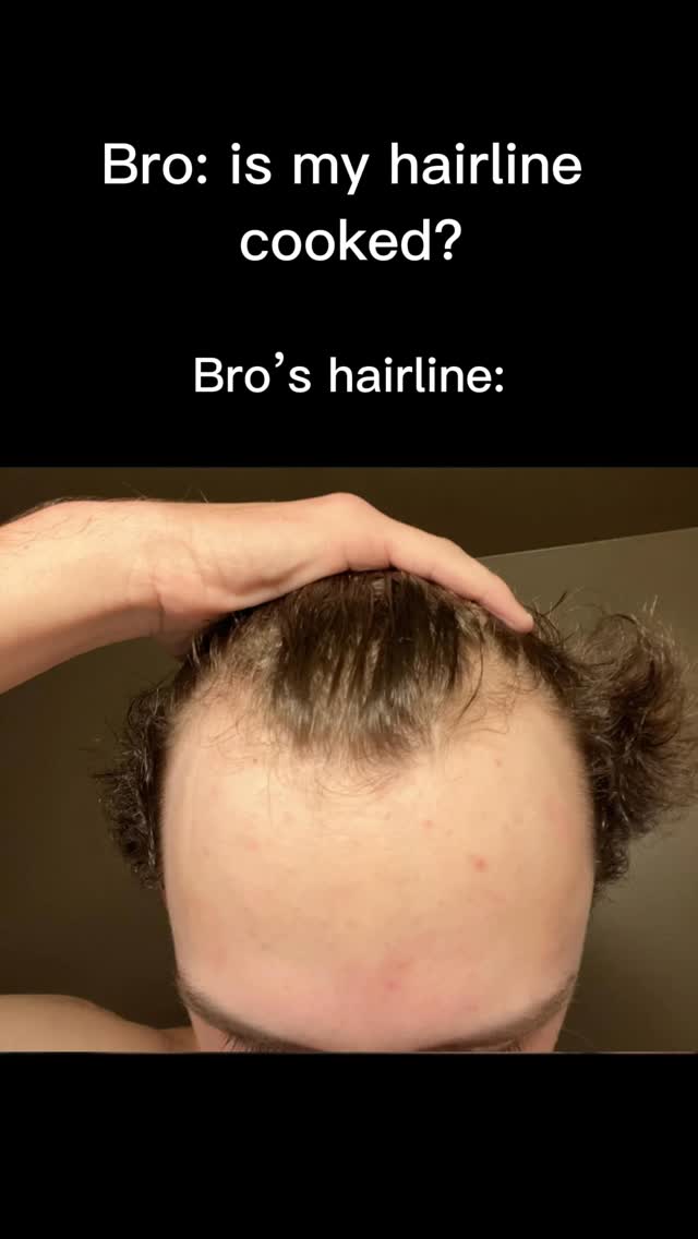 A close-up shot shows a man's forehead and hairline. The hairline shows signs of hair loss. Overlayed text asks if the hairline is "cooked".