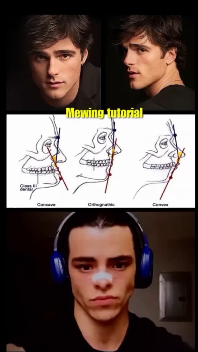 The image is a vertical collage. The top portion shows two headshot photos of the same man from the shoulders up, one facing forward and the other in profile, both against a dark background. Below this, a diagram of a skull is shown, with annotated lines and labels indicating dental classifications (concave, orthognathic, convex). Underneath, at the bottom, is a selfie of a man wearing blue headphones, looking at the camera, with a bandage on his nose.