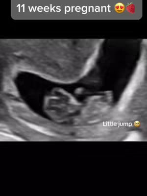 An ultrasound image of a fetus, with text overlays indicating the pregnancy stage. The image has a grayscale palette. The upper section displays the text '11 weeks pregnant' above the image.