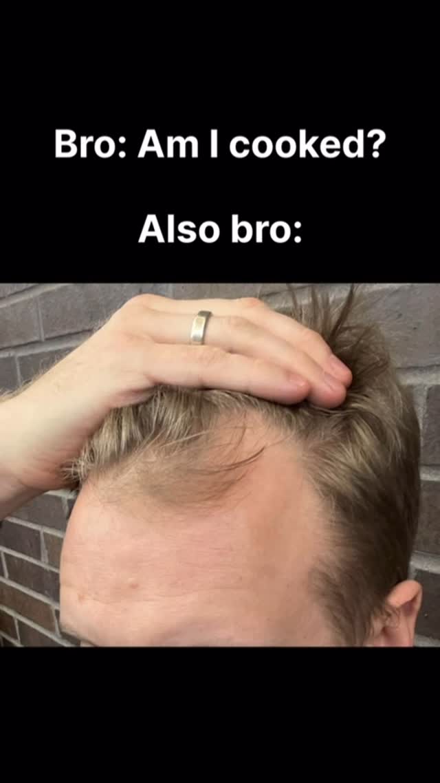 A close-up shot showing the top of a man's head and forehead. The man's hand is placed on the top of his head. The hair is thinning at the front, and the text overlayed on image poses a question about the hair. Solid black background.
