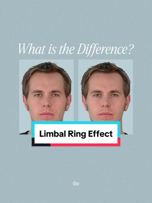 The cover image features a split view of a man's face, likely demonstrating the effect of a limbal ring. The man is positioned in the center, with two identical images of his face side-by-side. The background is a light blue-gray. Overlaid on top are the text elements: a white box with the question, "What is the Difference?" in black, centered at the top and a teal and white colored box with the text "Limbal Ring Effect" at the bottom.