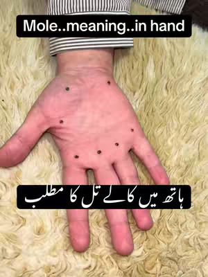 A close-up shot of a hand with several moles on the palm. The hand is fair-skinned, and the background appears to be a soft, textured surface, possibly fur or a rug. Two black rectangular text boxes overlay the image, one at the top and another at the bottom, both with white text.