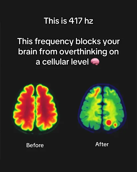 The image is a dark, informational graphic. Central to the image is a comparison of two brain scans, presented side-by-side. The scan on the left, labeled "Before," shows a brain with a strong red and orange color palette, indicating high activity levels. The scan on the right, labeled "After," presents a brain with a green and yellow palette, suggesting reduced activity. Above the brain scans, text in white font reads "This is 417 Hz" and "This frequency blocks your brain from overthinking on a cellular level."
