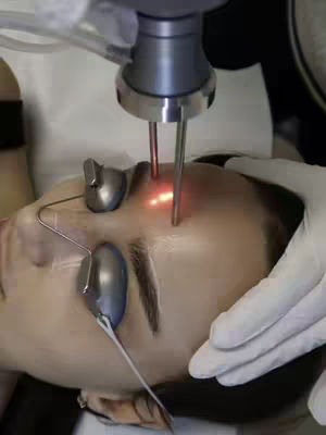 A close-up image shows the face of a person undergoing a cosmetic laser treatment. A silver device emitting a red laser beam is positioned over the person's forehead, with a light glowing where the laser hits the skin. Protective eyewear is in place. The person's face is tilted slightly upwards. The background is blurred, suggesting a clinical setting.