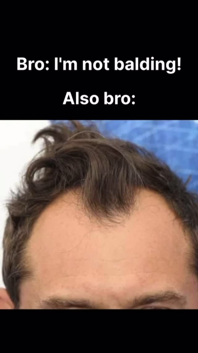The image shows a close-up of a man's forehead and the beginning of his hairline. The text overlay indicates concerns about balding.