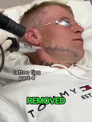 A close-up shot of a man's face during a tattoo removal procedure. The man is wearing glasses and a white hoodie with text. The overlay text reads 'tattoo tips part 4' and 'REMOVED' in a green bubble.