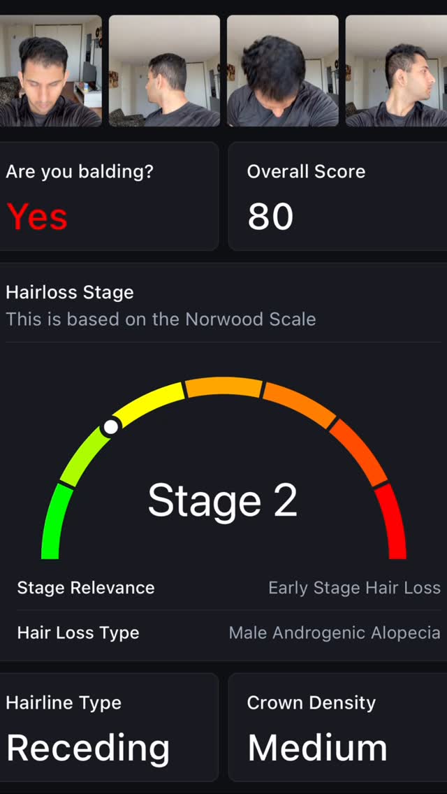 The image features a screen displaying a hair analysis app. The app shows four small images of a man from different angles, a question 'Are you balding?' with a 'Yes' answer in red, and an 'Overall Score' of 80. Below, the app shows a radial gauge indicating 'Stage 2' of hair loss, with details on hair loss type, hairline type, and crown density.